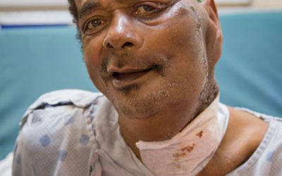 Sambany – the largest tumour Mercy Ships had ever seen